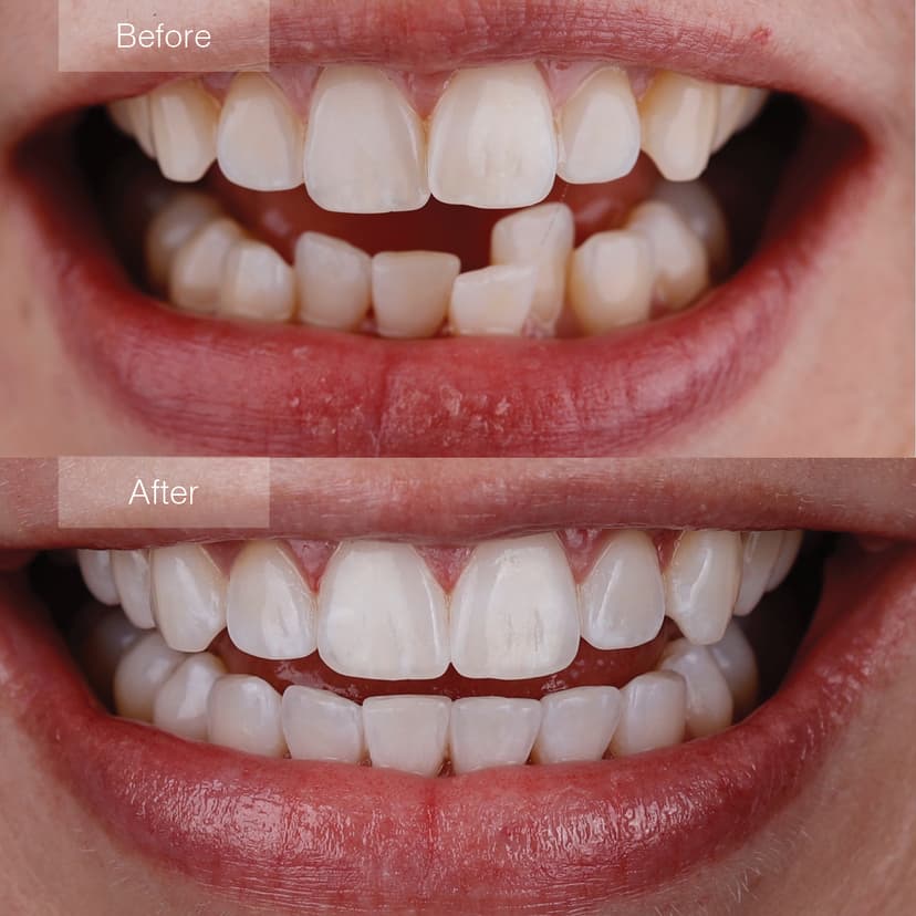 Invisalign Before and After Results