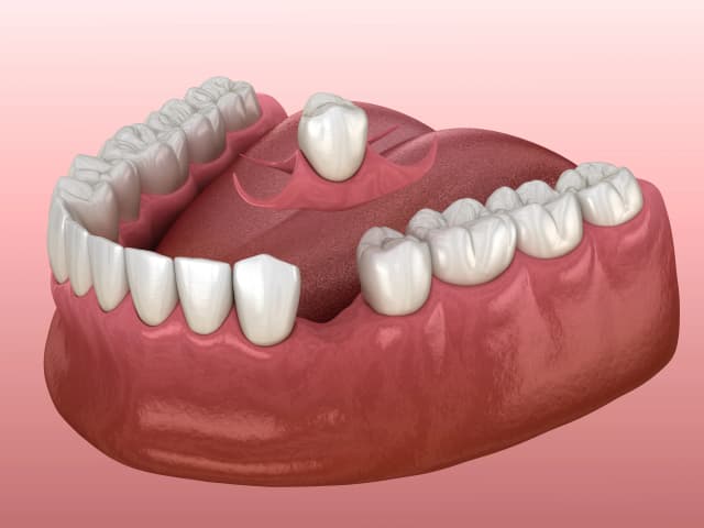 Immediate Dentures