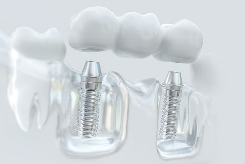 Multi-Implant Bridge