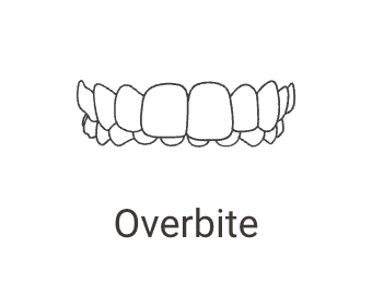 Overbite