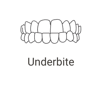 Underbite